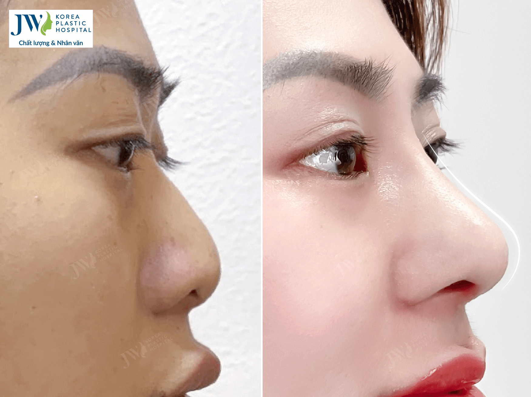 nang-mui-bang-sun-tu-than-benh-vien-jw