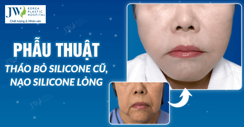 Phẫu thuật tháo bỏ silicone cũ, nạo silicone lỏng sau khi tiêm 30 năm