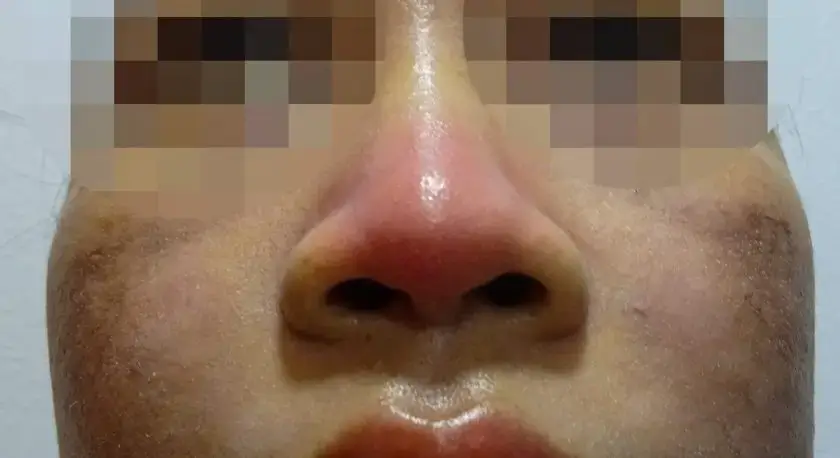 bien-chung-filler-nang-mui-bien-chung