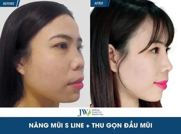 bien-chung-filler-nang-mui-hoa-hong-hinh-khach-hang