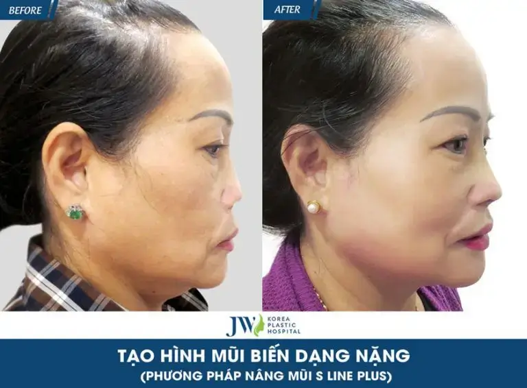 bien-chung-filler-nang-mui-khach-hang-co-loan