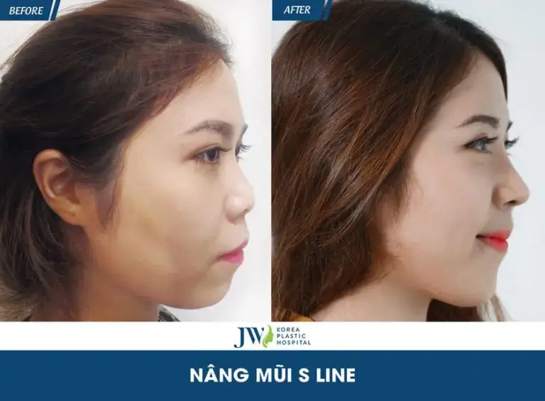 bien-chung-filler-nang-mui-khach-hang-hoang-anh-nang-mui-sline