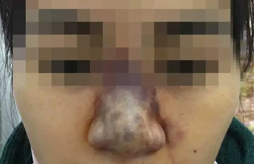 bien-chung-filler-nang-mui-mui-bam