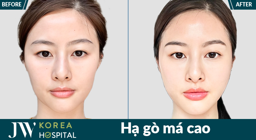 Hình ảnh khách hàng trước và sau hạ gò má cao tại Bệnh viện JW