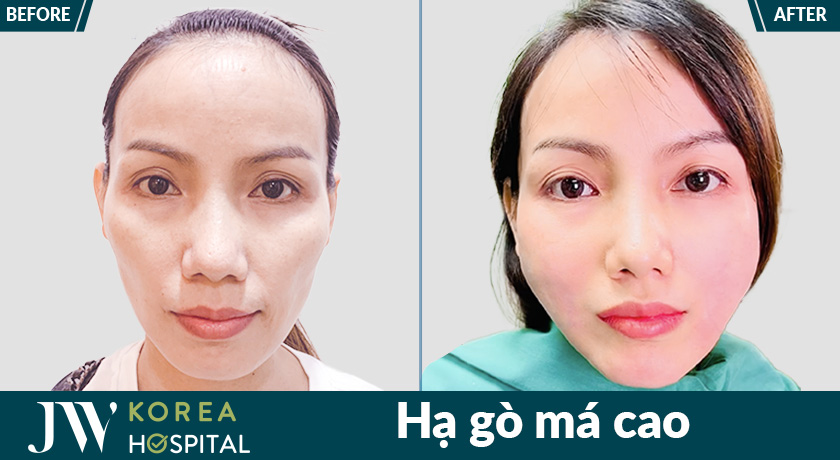 Kết quả sau khi hạ gò má cao tại Bệnh viện JW 