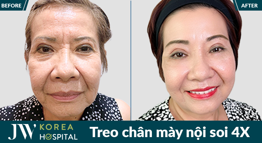ket qua thay doi ngoan muc sau treo chan may noi soi 4x tai jw 1 458x251