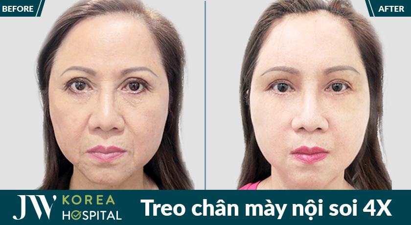 ket qua thay doi ngoan muc sau treo chan may noi soi 4x tai jw 2