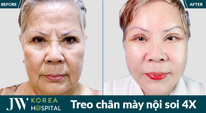 Kết quả treo chân mày nội soi 4X