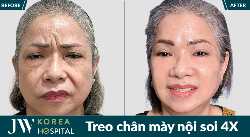 Treo chân mày nội soi 4X giúp xóa nếp nhăn, rãnh râu rồng, vết chân chim hiệu quả
