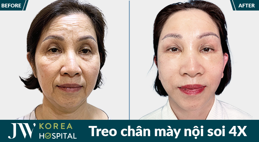 ket qua thay doi ngoan muc sau treo chan may noi soi 4x tai jw