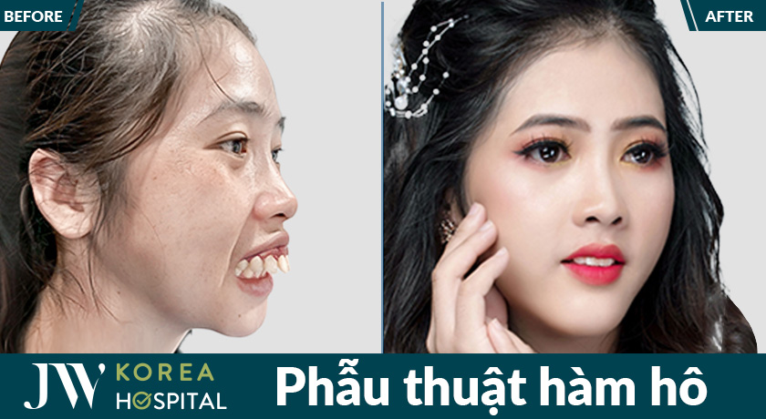 Phẫu thuật hàm hô tại JW giúp khuôn mặt cân đối và hài hòa rõ rệt