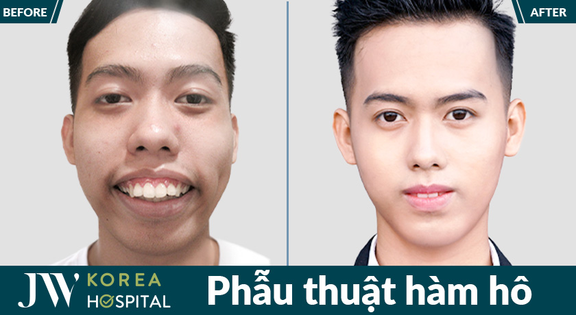 Phẫu thuật hàm hô giúp điều chỉnh xương hàm, tăng tính thẩm mỹ khuôn mặt