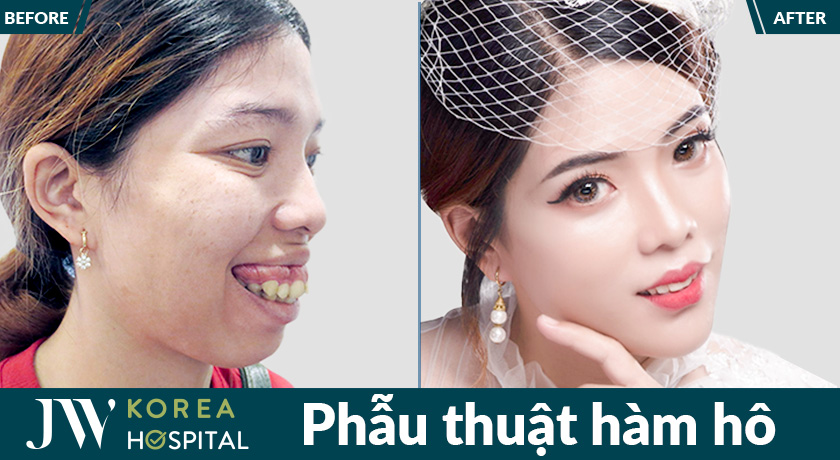 Kết quả trước và sau phẫu thuật hàm hô tại bệnh viện JW