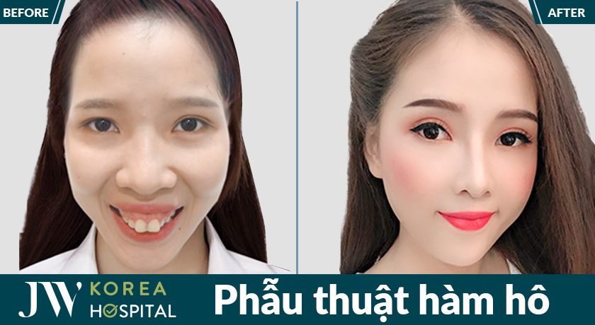 Phẫu thuật hàm hô giúp điều chỉnh cấu trúc xương hàm, cải thiện đường nét khuôn mặt