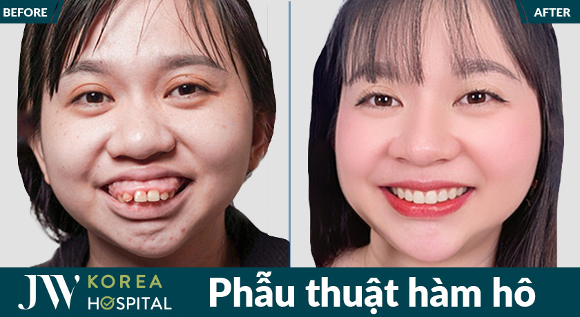 Phẫu thuật hàm hô tại Bệnh viện JW giúp cải thiện khớp cắn và thẩm mỹ khuôn mặt.