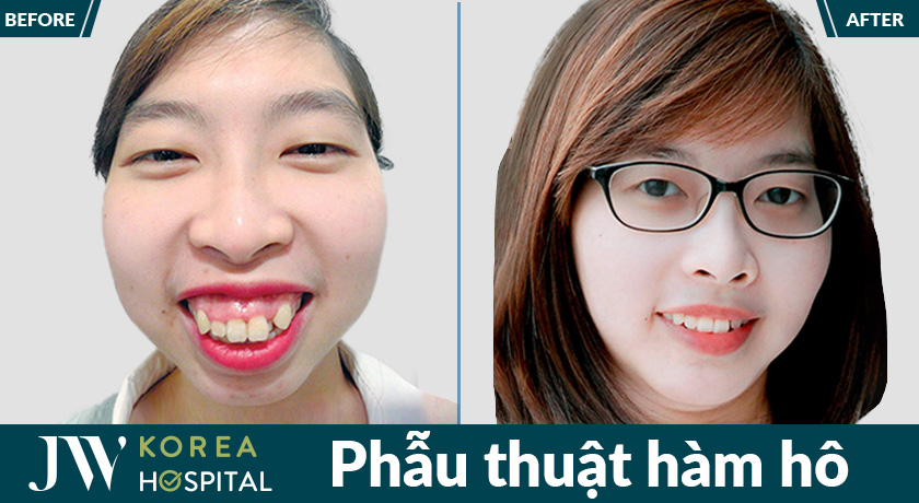 Phẫu thuật hàm hô giúp lấy lại khớp cắn chuẩn và nụ cười tự tin hơn