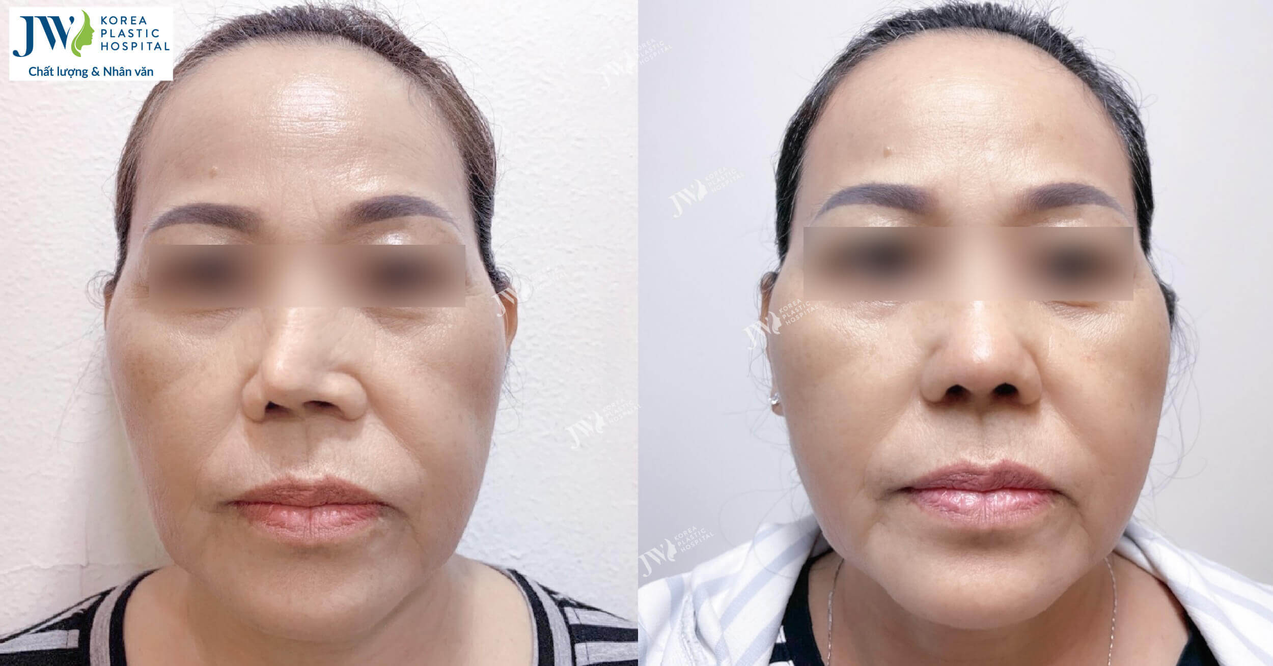 Nâng mũi sụn sườn: Giải cứu mũi co rút cho quý cô Việt Kiều