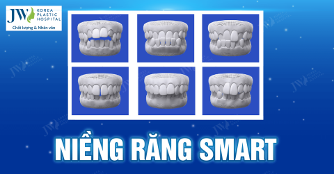 Niềng răng SMART gồm những loại nào? Niềng răng ở đâu tốt?