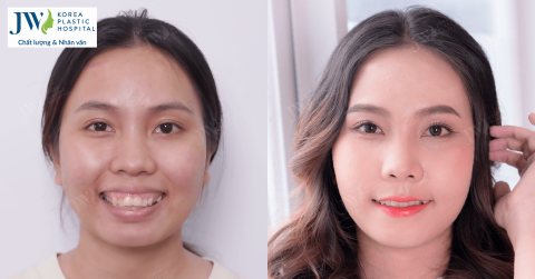 Phẫu thuật hàm hô – giải pháp giúp bạn thay đổi ngoạn mục