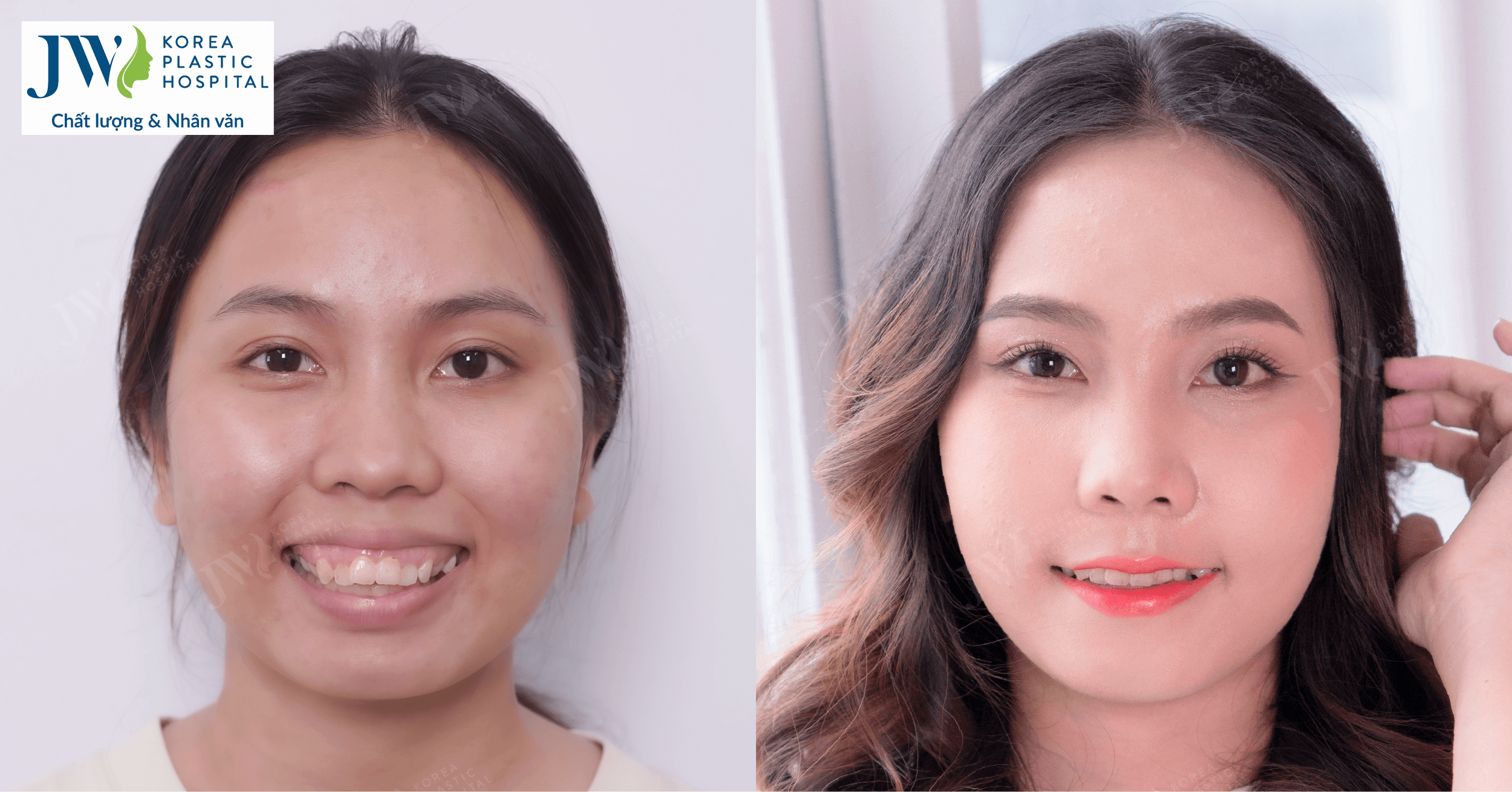 Phẫu thuật hàm hô – giải pháp giúp bạn thay đổi ngoạn mục