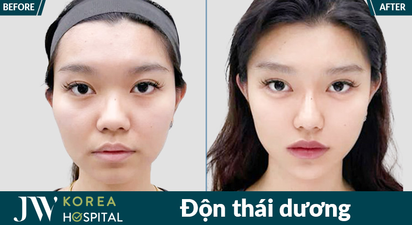 Độn thái dương an toàn, hiệu quả cao tại bệnh viện JW