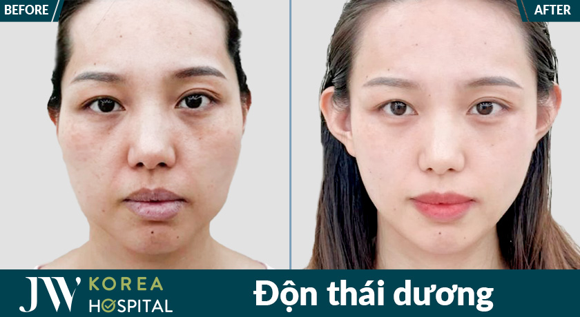 Quy trình độn thái dương tại bệnh viện JW được thực hiện trong môi trường vô trùng, an toàn, đạt chuẩn y khoa