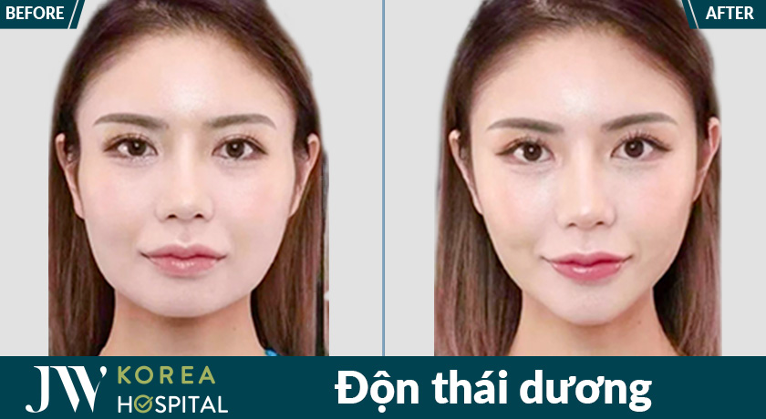 Thái dương đầy đặn, gương mặt hài hòa chỉ sau quá trình độn thái dương tại bệnh viện JW