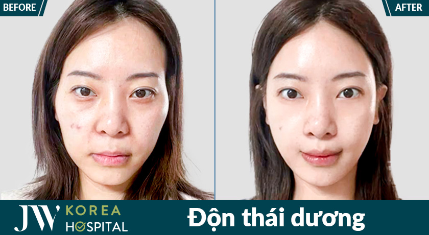 Khắc phục thái dương hõm lâu năm chỉ sau 1 quá trình thực hiện tại bệnh viện JW