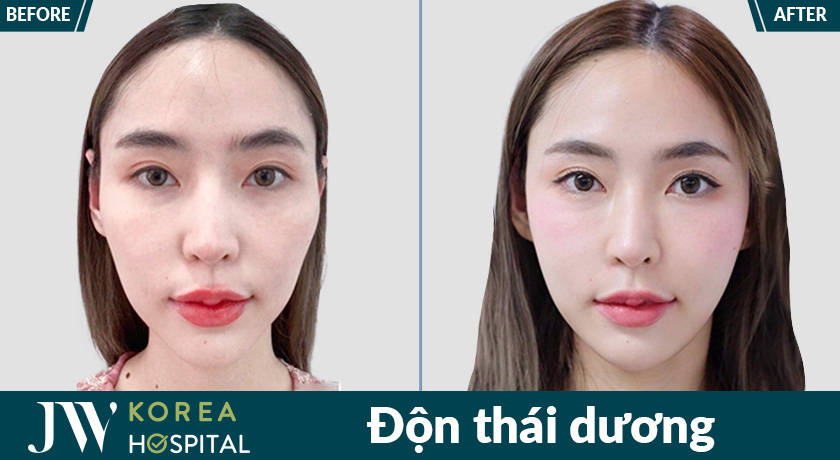 Cải thiện gương mặt gầy, thiếu sức sống, lấy lại thần thái tự tin, rạng rỡ với độn thái dương tại bệnh viện JW