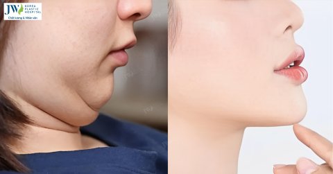 Bí mật về mỡ nọng cằm mà bạn chưa biết?