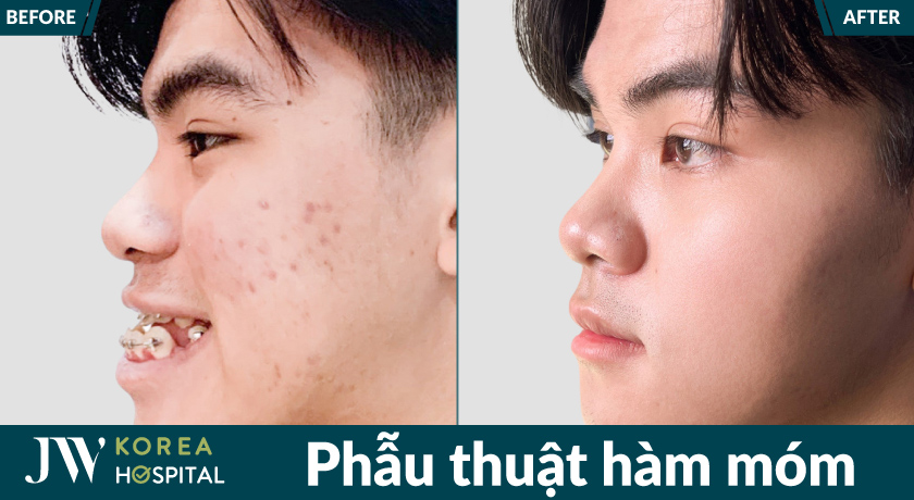 Quy trình phẫu thuật hàm móm tại JW chuẩn y khoa, đảm bảo an toàn và hiệu quả điều trị