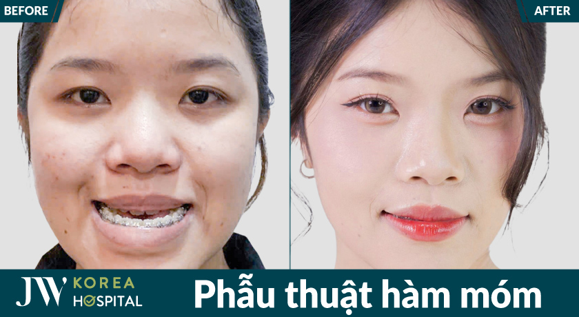 Phẫu thuật chỉnh hàm móm giúp cải thiện chức năng ăn nhai và thẩm mỹ khuôn mặt