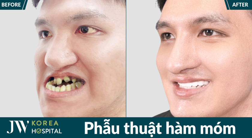Phẫu thuật hàm móm tại Bệnh viện JW giúp cải thiện khớp cắn và thẩm mỹ khuôn mặt