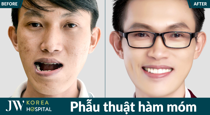 Kết quả phẫu thuật hàm móm của khách hàng tại bệnh viện JW
