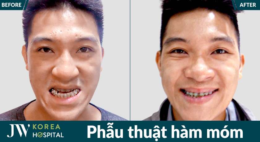 Kết quả sau phẫu thuật hàm móm tại bệnh viện JW giúp khuôn mặt hài hòa và tự tin hơn khi giao tiếp