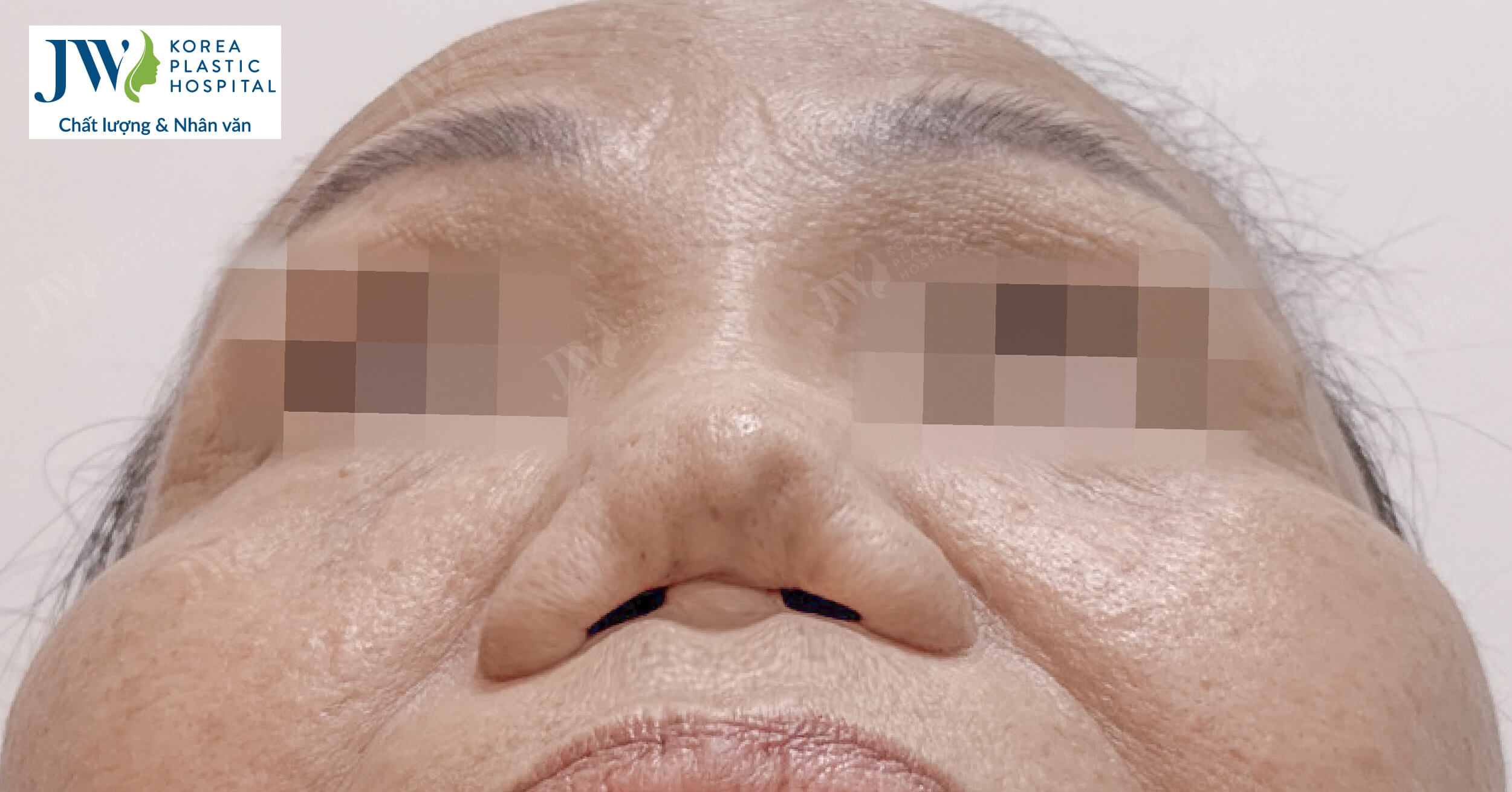 Bán cả gia tài, sửa mũi 7 lần khiến người phụ nữ Miền tây suýt tắt thở