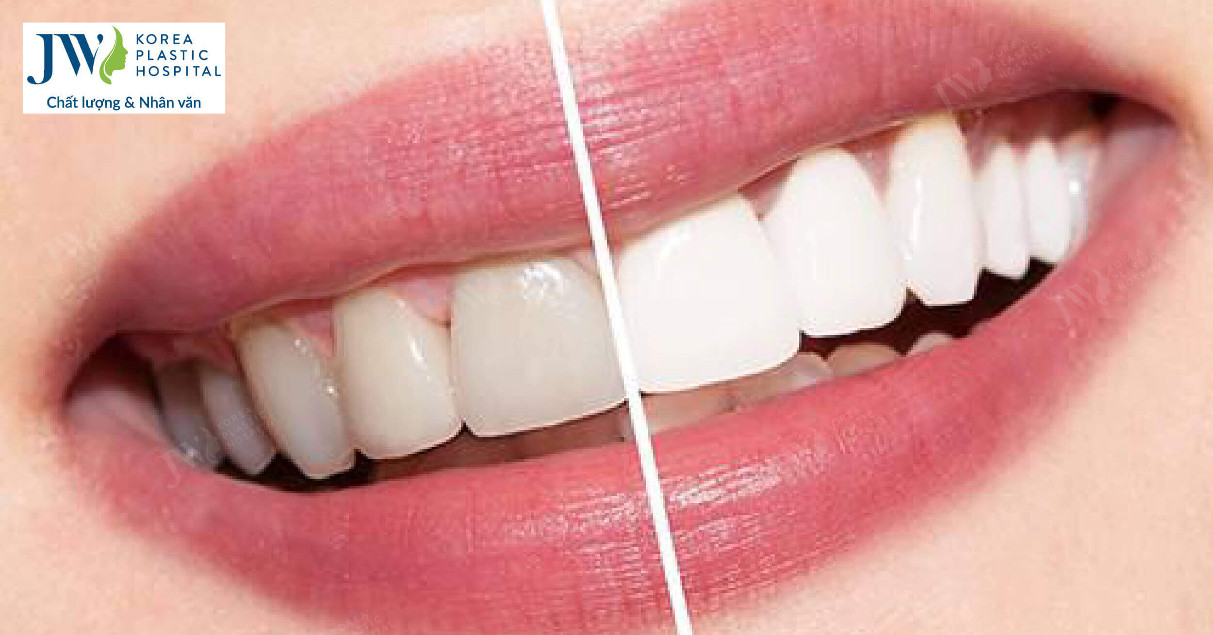 5 thói quen khiến tình trạng răng của bạn tệ đi từng ngày