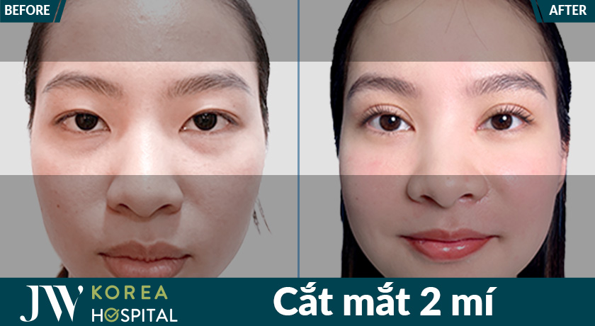 Cắt mắt 2 mí tại Bệnh viện JW mang lại mắt to tròn, long lanh được nhiều khách hàng Gen Z lựa chọn