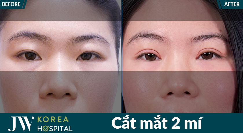 Cắt mắt 2 mí tại Bệnh viện JW mang lại kết quả mắt to, tròn, gương mặt có điểm nhấn và sức hút hơn