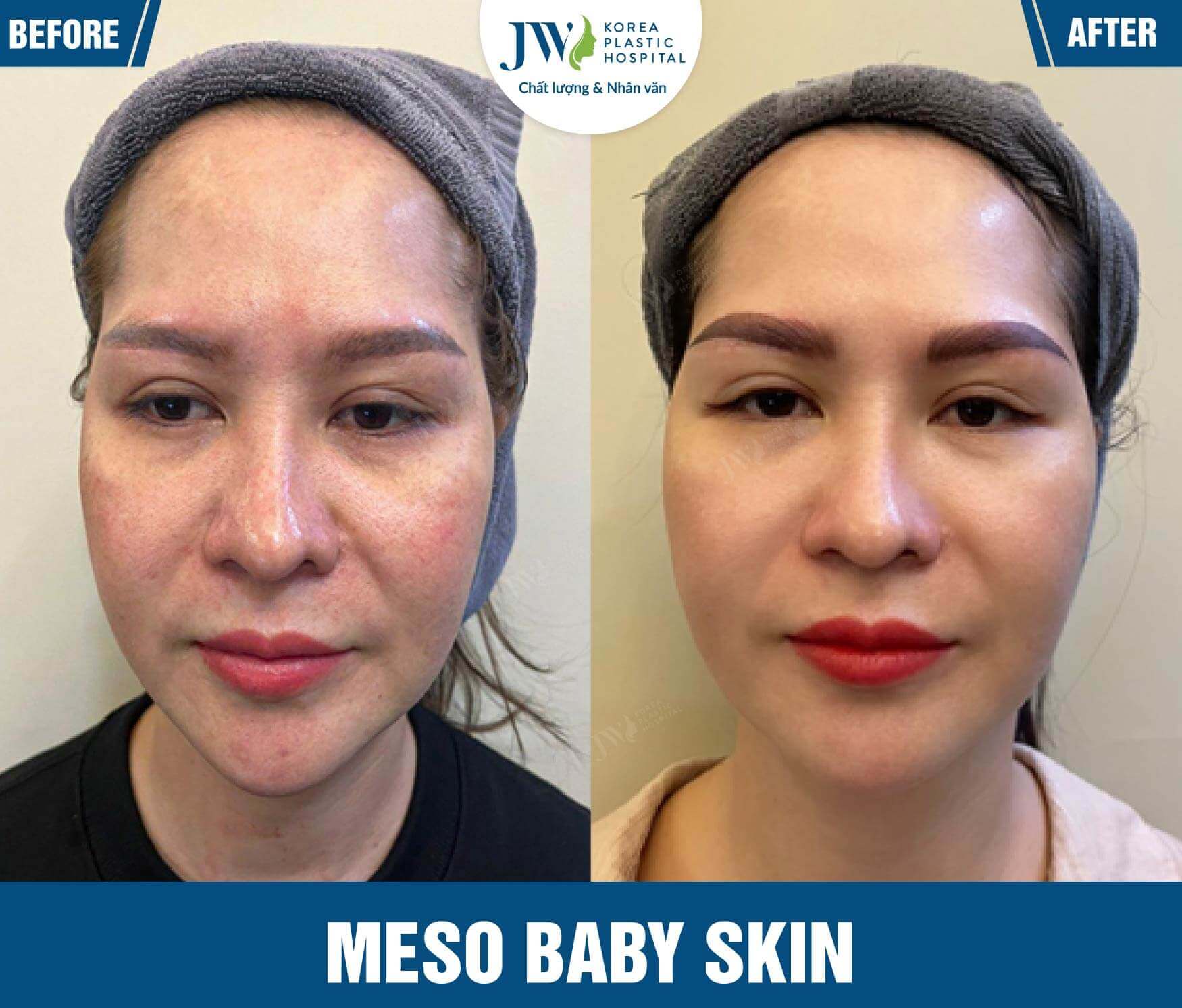 cong nghe meso baby skin