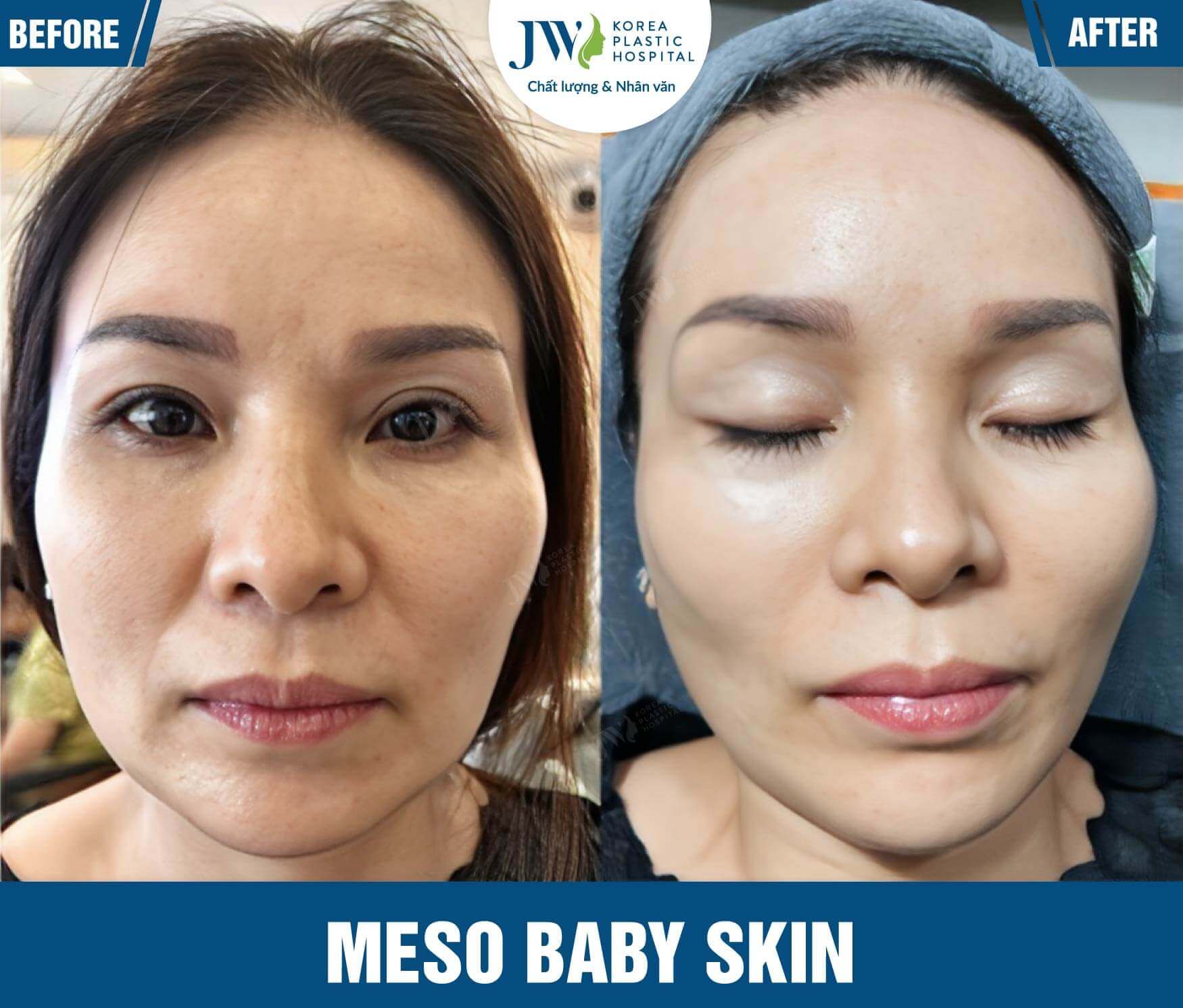 meso baby skin giam tham vung mat