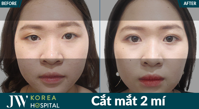 Khắc phục tình trạng không mí, mí lót, sở hữu mắt to tròn với Cắt mắt 2 mí tại Bệnh viện JW