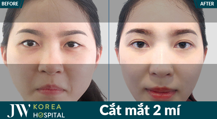 Kết quả cắt mắt 2 mí tại bệnh viện JW mang đến đôi mắt to tròn, long lanh, đầy cuốn hút