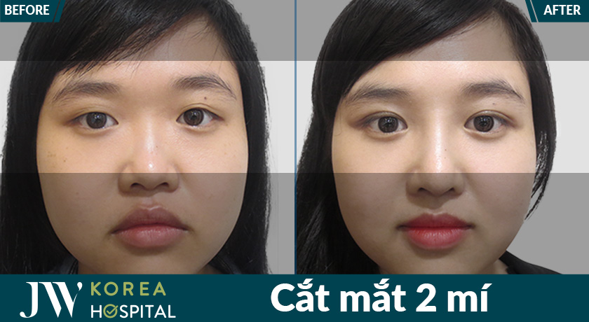 100% khách hàng hài lòng với kết quả sau cắt mắt 2 mí tại Bệnh viện JW