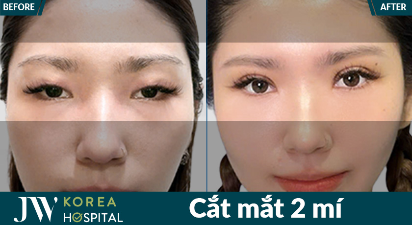 Mắt to tròn long lanh như búp bê sau 7 ngày cắt mắt tại Bệnh viện JW