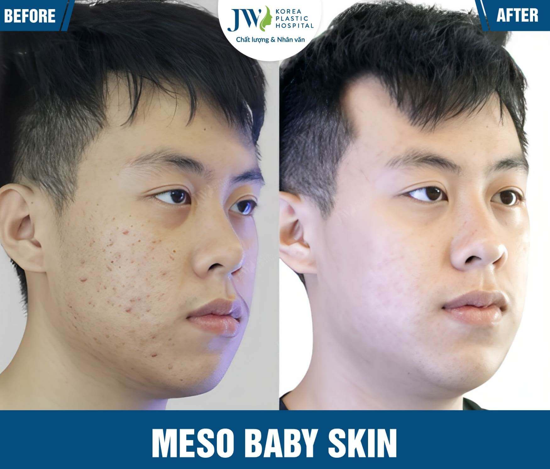 meso baby skin JW