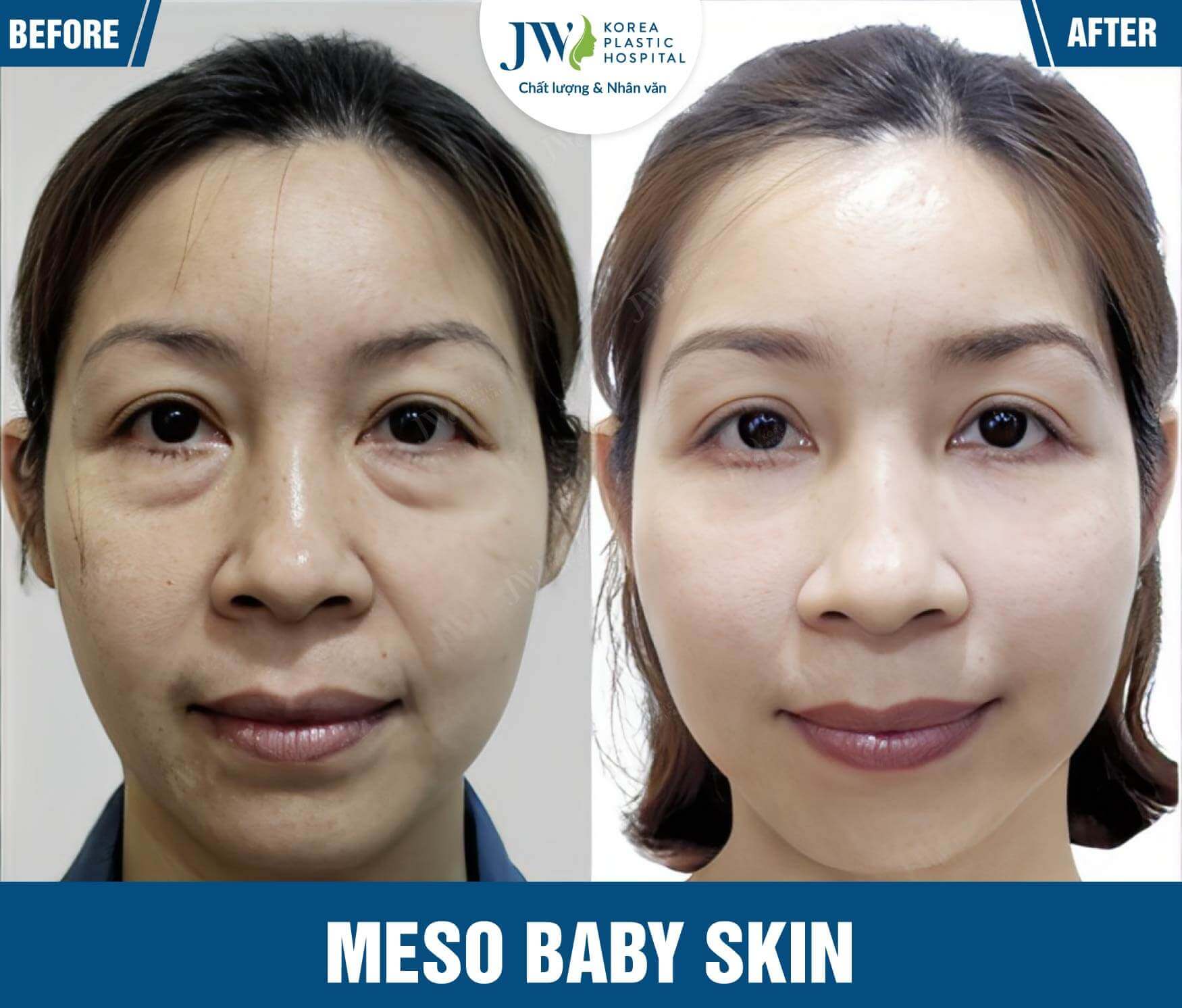 meso baby skin JW-3