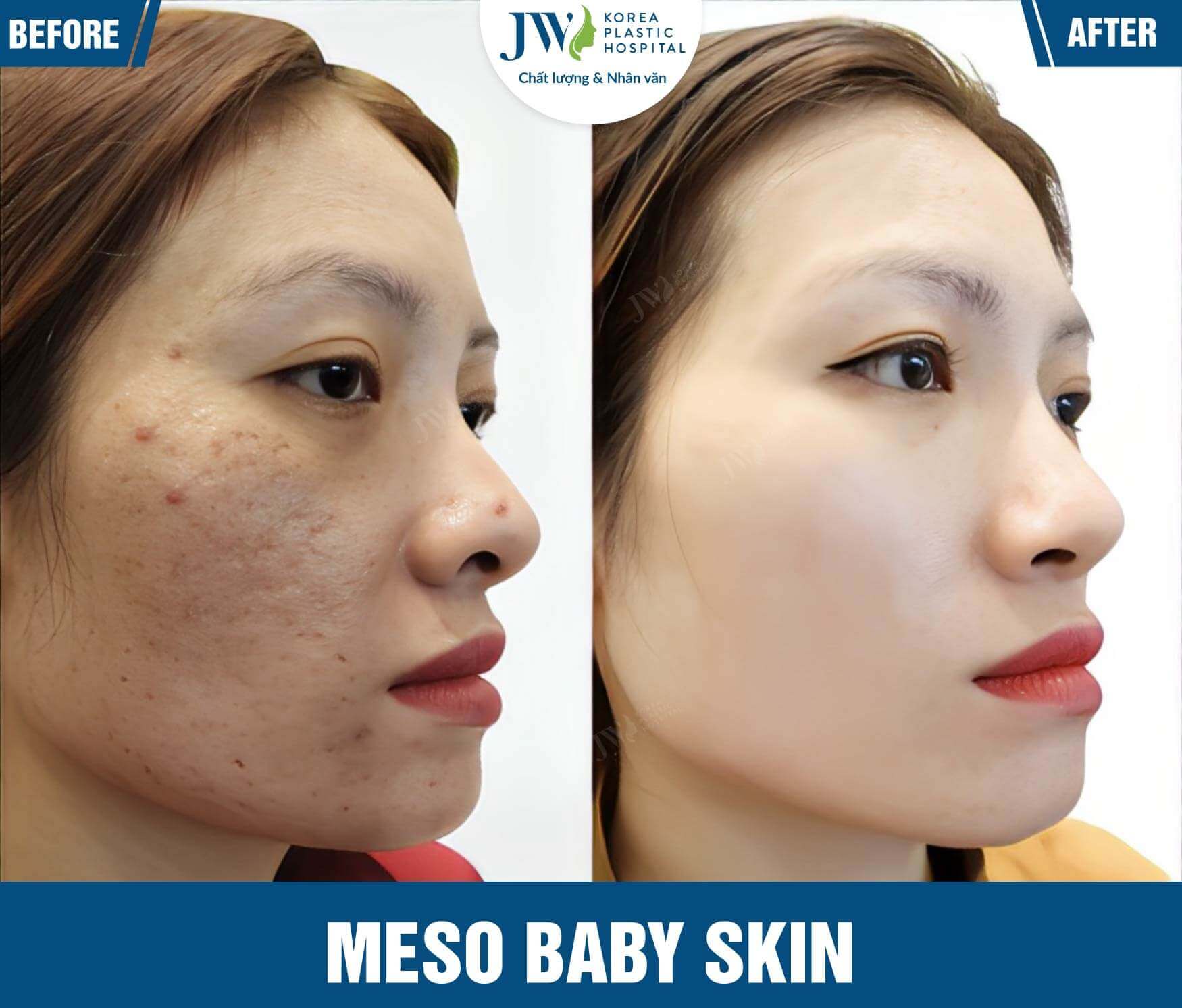 meso baby skin JW-1