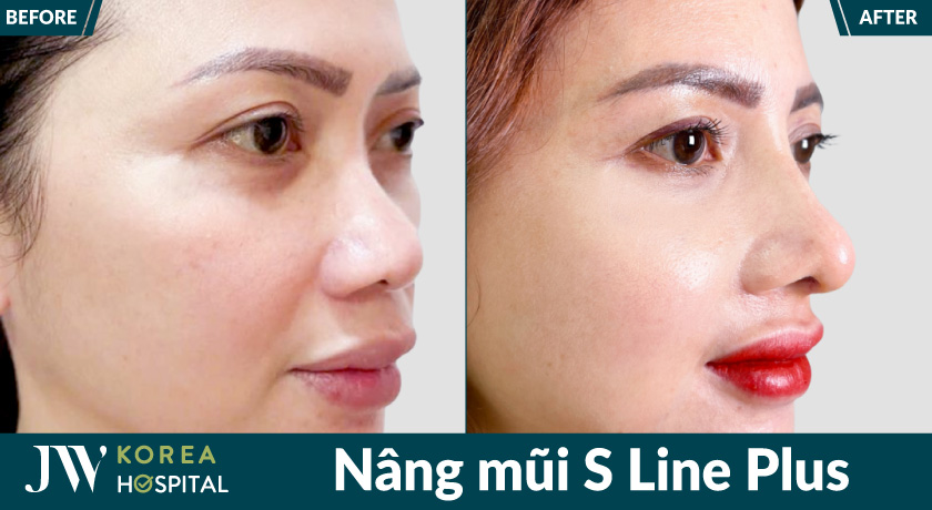 Nâng mũi S Line Plus tạo đường cong tự nhiên, mềm mại cho dáng mũi, giúp gương mặt cân đối, cuốn hút hơn