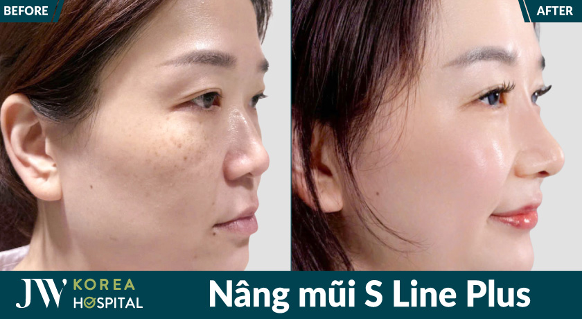 Dáng mũi mềm mại, tự nhiên sau nâng mũi S Line Plus tại JW